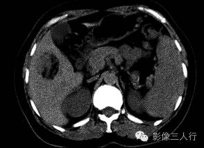 【病例】肝血管平滑肌脂肪瘤1例CT