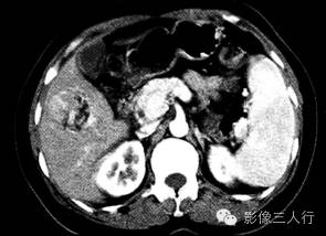 【病例】肝血管平滑肌脂肪瘤1例CT 【病例】肝血管平滑肌脂肪瘤1例CT