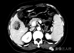 【病例】肝血管平滑肌脂肪瘤1例CT 【病例】肝血管平滑肌脂肪瘤1例CT