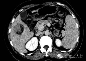 【病例】肝血管平滑肌脂肪瘤1例CT 【病例】肝血管平滑肌脂肪瘤1例CT