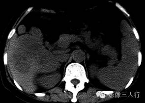 【病例】肝弥漫性大B细胞淋巴瘤1例CT影像分析