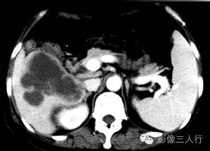 【病例】肝弥漫性大B细胞淋巴瘤1例CT影像分析 【病例】肝弥漫性大B细胞淋巴瘤1例CT影像分析