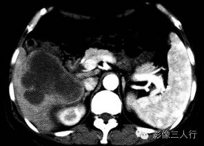 【病例】肝弥漫性大B细胞淋巴瘤1例CT影像分析 【病例】肝弥漫性大B细胞淋巴瘤1例CT影像分析