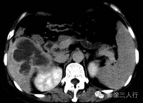【病例】肝弥漫性大B细胞淋巴瘤1例CT影像分析 【病例】肝弥漫性大B细胞淋巴瘤1例CT影像分析