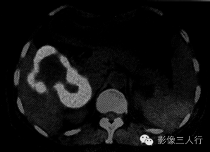 【病例】肝弥漫性大B细胞淋巴瘤1例CT影像分析 【病例】肝弥漫性大B细胞淋巴瘤1例CT影像分析