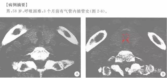 【病例】气管缩窄1例CT影像表现