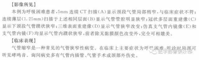 【病例】气管缩窄1例CT影像表现