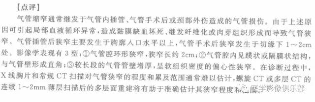 【病例】气管缩窄1例CT影像表现
