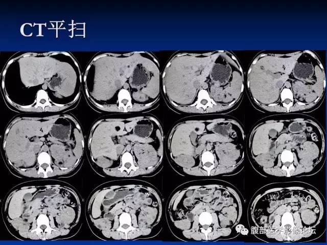 【病例】结节性硬化、肝肾血管平滑肌脂肪瘤、肺淋巴管肌瘤病一例CT 【病例】结节性硬化、肝肾血管平滑肌脂肪瘤、肺淋巴管肌瘤病一例CT