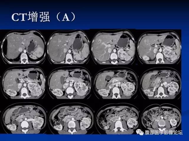 【病例】结节性硬化、肝肾血管平滑肌脂肪瘤、肺淋巴管肌瘤病一例CT 【病例】结节性硬化、肝肾血管平滑肌脂肪瘤、肺淋巴管肌瘤病一例CT