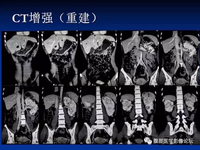 【病例】结节性硬化、肝肾血管平滑肌脂肪瘤、肺淋巴管肌瘤病一例CT 【病例】结节性硬化、肝肾血管平滑肌脂肪瘤、肺淋巴管肌瘤病一例CT