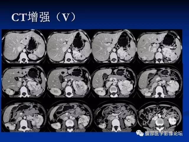 【病例】结节性硬化、肝肾血管平滑肌脂肪瘤、肺淋巴管肌瘤病一例CT 【病例】结节性硬化、肝肾血管平滑肌脂肪瘤、肺淋巴管肌瘤病一例CT