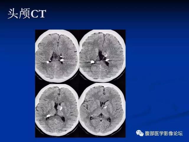 【病例】结节性硬化、肝肾血管平滑肌脂肪瘤、肺淋巴管肌瘤病一例CT 【病例】结节性硬化、肝肾血管平滑肌脂肪瘤、肺淋巴管肌瘤病一例CT