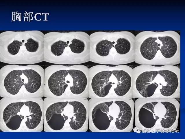 【病例】结节性硬化、肝肾血管平滑肌脂肪瘤、肺淋巴管肌瘤病一例CT 【病例】结节性硬化、肝肾血管平滑肌脂肪瘤、肺淋巴管肌瘤病一例CT