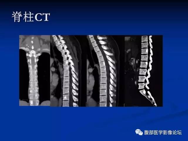 【病例】结节性硬化、肝肾血管平滑肌脂肪瘤、肺淋巴管肌瘤病一例CT 【病例】结节性硬化、肝肾血管平滑肌脂肪瘤、肺淋巴管肌瘤病一例CT