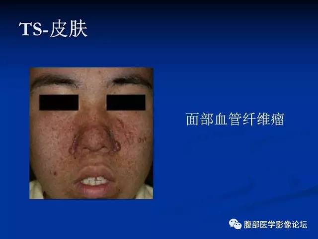 【病例】结节性硬化、肝肾血管平滑肌脂肪瘤、肺淋巴管肌瘤病一例CT 【病例】结节性硬化、肝肾血管平滑肌脂肪瘤、肺淋巴管肌瘤病一例CT
