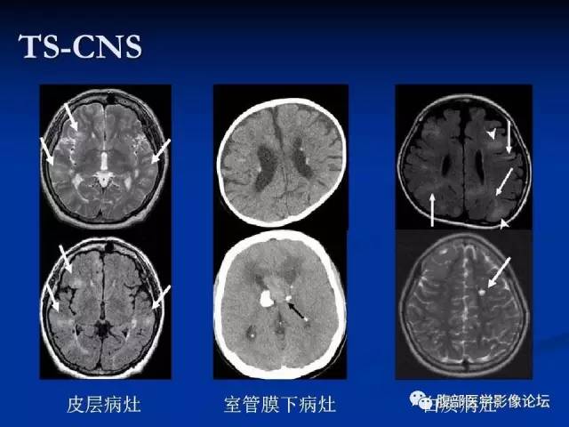 【病例】结节性硬化、肝肾血管平滑肌脂肪瘤、肺淋巴管肌瘤病一例CT 【病例】结节性硬化、肝肾血管平滑肌脂肪瘤、肺淋巴管肌瘤病一例CT
