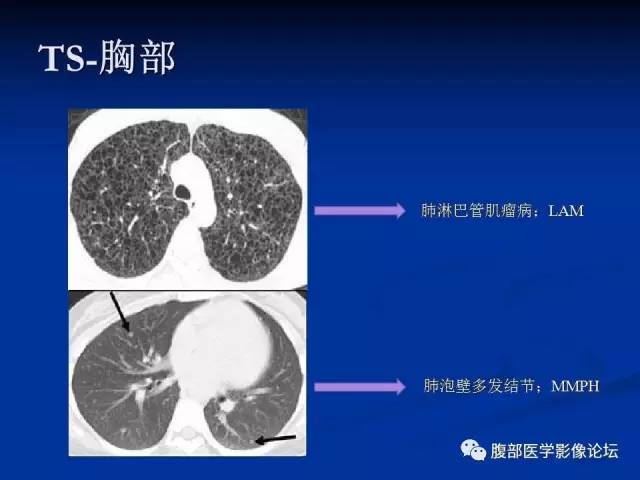 【病例】结节性硬化、肝肾血管平滑肌脂肪瘤、肺淋巴管肌瘤病一例CT 【病例】结节性硬化、肝肾血管平滑肌脂肪瘤、肺淋巴管肌瘤病一例CT