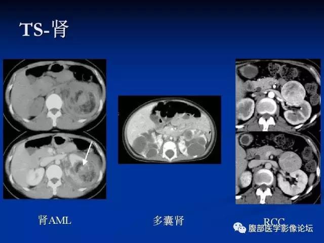 【病例】结节性硬化、肝肾血管平滑肌脂肪瘤、肺淋巴管肌瘤病一例CT 【病例】结节性硬化、肝肾血管平滑肌脂肪瘤、肺淋巴管肌瘤病一例CT
