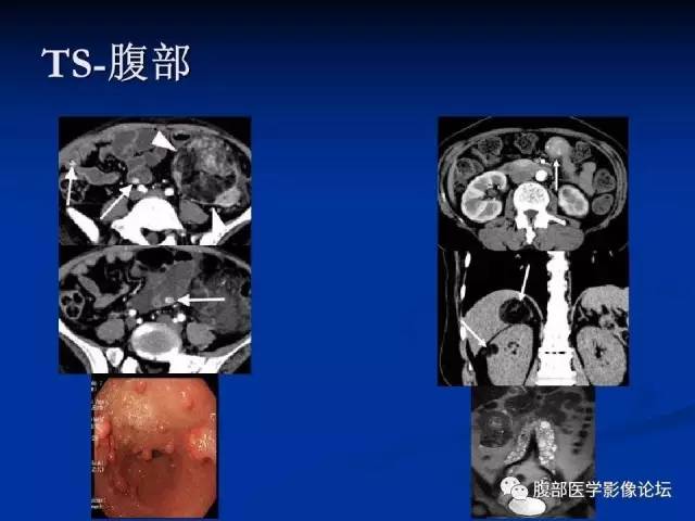 【病例】结节性硬化、肝肾血管平滑肌脂肪瘤、肺淋巴管肌瘤病一例CT 【病例】结节性硬化、肝肾血管平滑肌脂肪瘤、肺淋巴管肌瘤病一例CT
