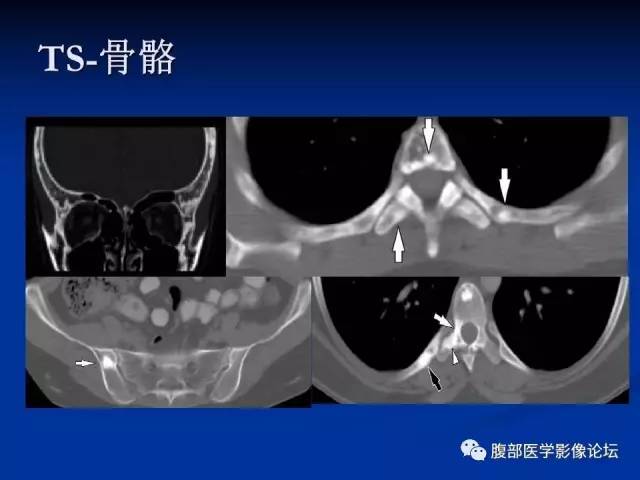 【病例】结节性硬化、肝肾血管平滑肌脂肪瘤、肺淋巴管肌瘤病一例CT 【病例】结节性硬化、肝肾血管平滑肌脂肪瘤、肺淋巴管肌瘤病一例CT