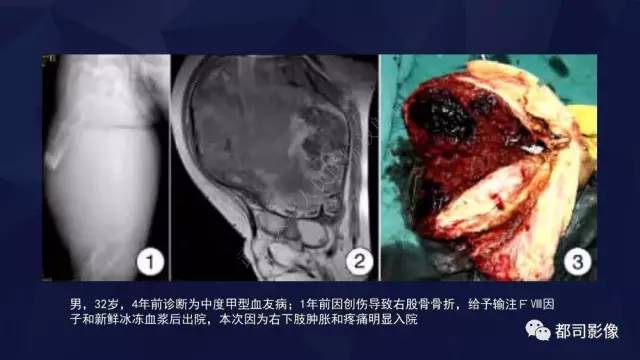【PPT】血友病性假肿瘤影像诊断