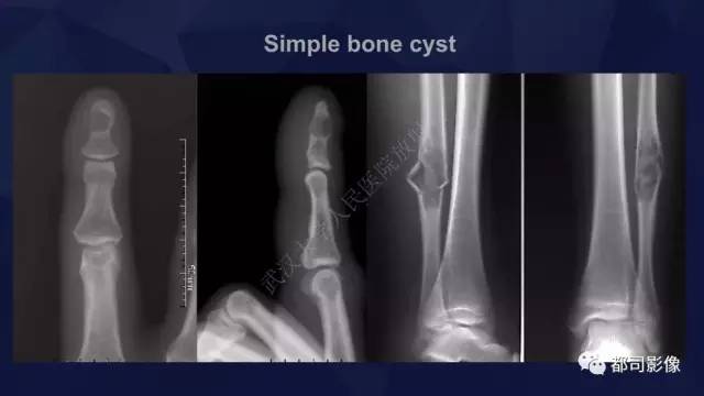 【PPT】血友病性假肿瘤影像诊断