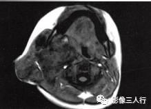 【病例】颈部淋巴管瘤1例MR影像表现分析 【病例】颈部淋巴管瘤1例MR影像表现分析