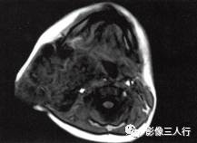 【病例】颈部淋巴管瘤1例MR影像表现分析 【病例】颈部淋巴管瘤1例MR影像表现分析