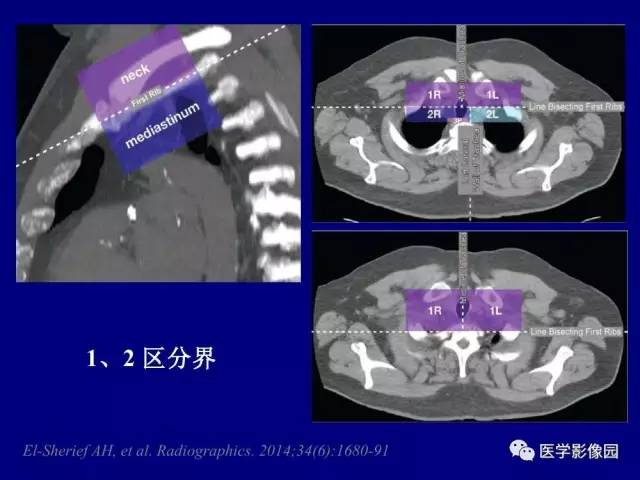 【PPT】肺癌影像诊断及进展