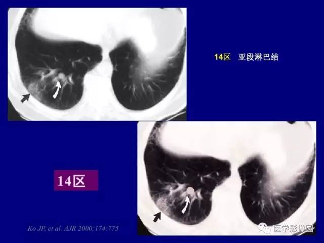 【PPT】肺癌影像诊断及进展