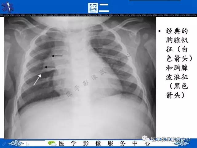 【影像征象】帆征和波浪征