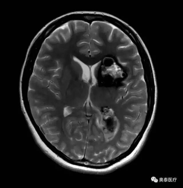 【病例】颅内多发海绵状血管瘤1例MR影像表现