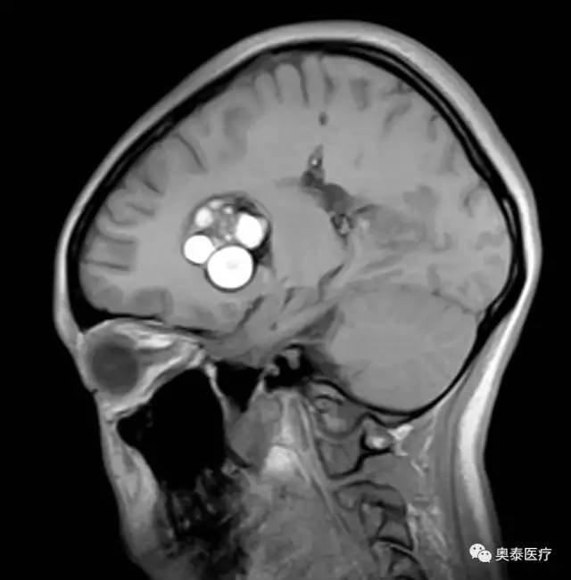 【病例】颅内多发海绵状血管瘤1例MR影像表现 【病例】颅内多发海绵状血管瘤1例MR影像表现