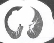 “分叶征” 的影像表现与临床意义 “分叶征” 的影像表现与临床意义