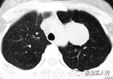 【病例】肺硬化性血管瘤1例CT影像表现 【病例】肺硬化性血管瘤1例CT影像表现