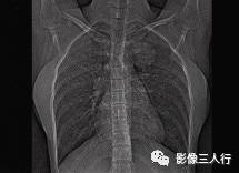【病例】肺硬化性血管瘤1例CT影像表现 【病例】肺硬化性血管瘤1例CT影像表现