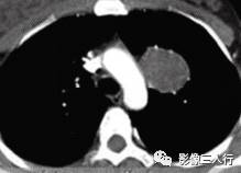 【病例】肺硬化性血管瘤1例CT影像表现 【病例】肺硬化性血管瘤1例CT影像表现