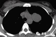 【病例】肺硬化性血管瘤1例CT影像表现 【病例】肺硬化性血管瘤1例CT影像表现