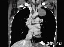 【病例】肺硬化性血管瘤1例CT影像表现 【病例】肺硬化性血管瘤1例CT影像表现