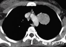 【病例】肺硬化性血管瘤1例CT影像表现