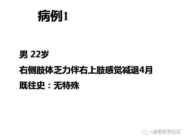 【病例】毛细胞型星形细胞瘤1例MR影像表现
