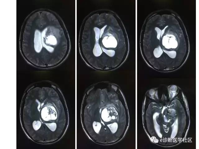 【病例】毛细胞型星形细胞瘤1例MR影像表现