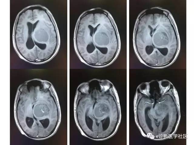 【病例】毛细胞型星形细胞瘤1例MR影像表现