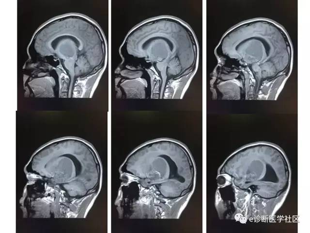 【病例】毛细胞型星形细胞瘤1例MR影像表现