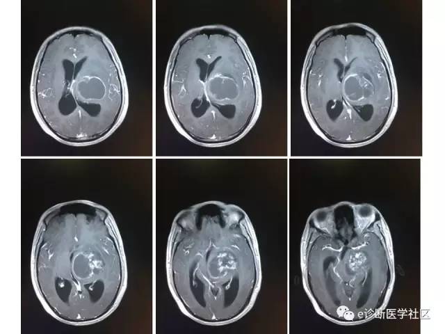 【病例】毛细胞型星形细胞瘤1例MR影像表现