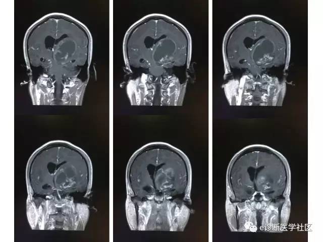 【病例】毛细胞型星形细胞瘤1例MR影像表现