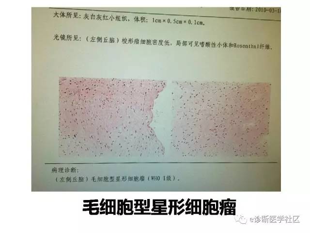 【病例】毛细胞型星形细胞瘤1例MR影像表现