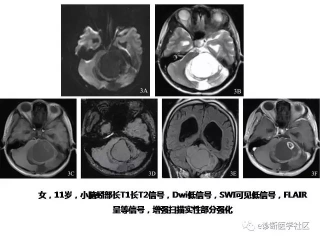 【病例】毛细胞型星形细胞瘤1例MR影像表现