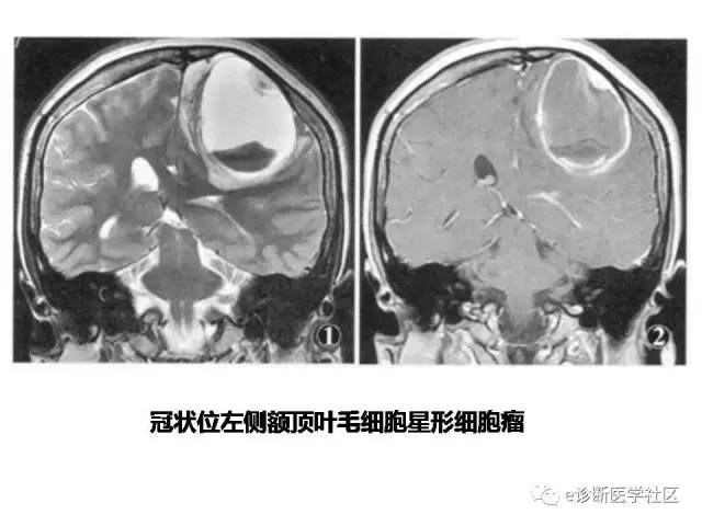 【病例】毛细胞型星形细胞瘤1例MR影像表现